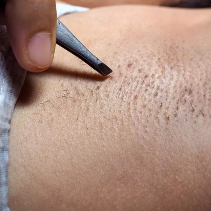 Thói quen cạo, nhổ lông là nguyên nhân dẫn đến lông mọc ngược