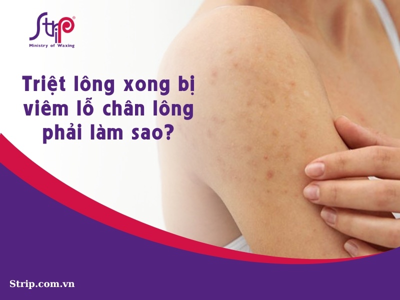 Triệt lông xong bị viêm lỗ chân lông phải làm sao