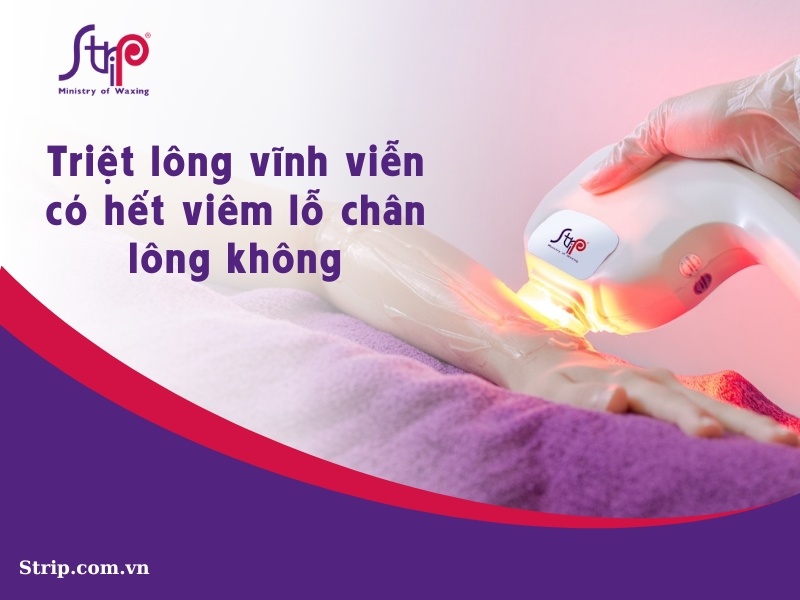 Triệt lông vĩnh viễn có hết viêm lỗ chân lông không?